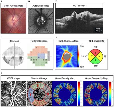 Topographic Quadrant Analysis of Peripapillary Superficial Microvasculature in Optic Disc Drusen